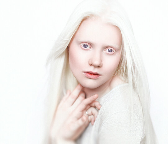 Itu albino apa My Dream: