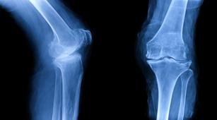 Faktor Risiko Seseorang Alami Osteogenesis Imperfecta