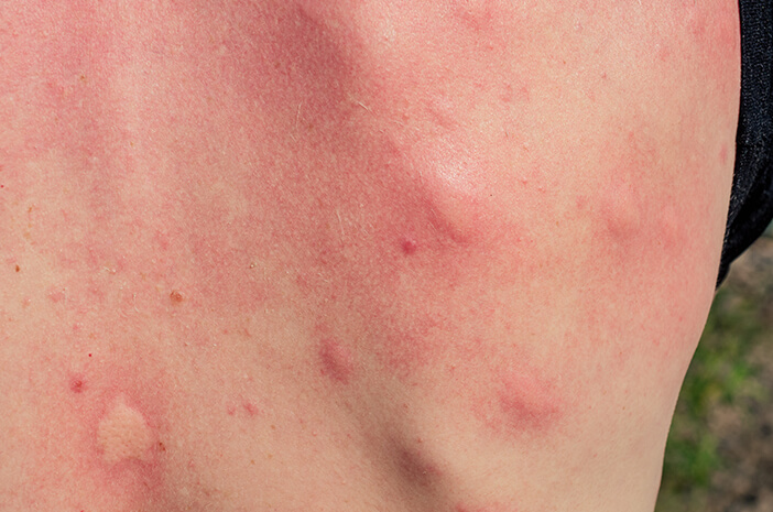 Faktor yang Meningkatkan Risiko Terkena Lichen Planus Faktor yang Meningkatkan Risiko Terkena Lichen Planus