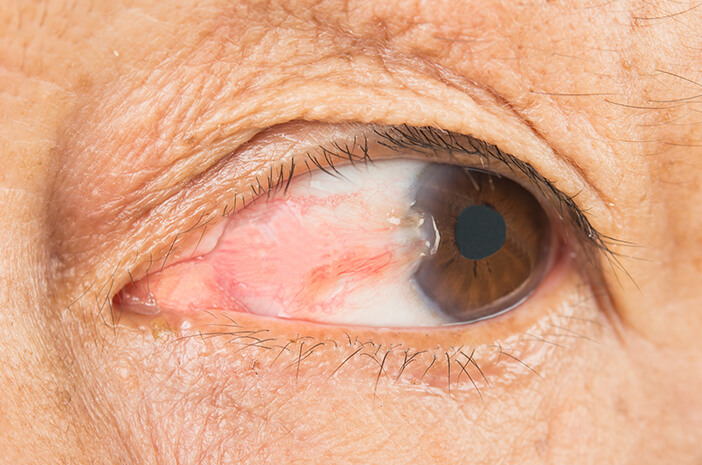 Harus Tahu, Ini Cara Diagnosis Pterygium Harus Tahu, Ini Cara Diagnosis Pterygium