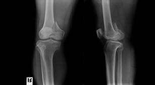 Hati-Hati, Alami Patah Tulang Dapat Sebabkan Osteoarthritis
