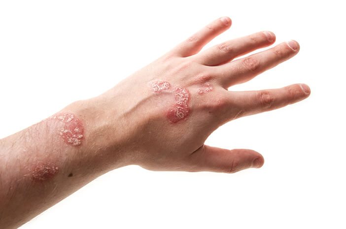 Hati-Hati, Ini Komplikasi Akibat Neurodermatitis Hati-Hati, Ini Komplikasi Akibat Neurodermatitis