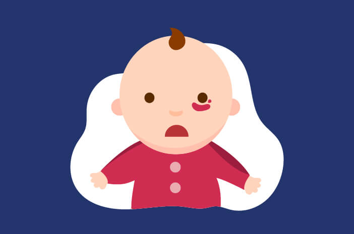 Ketahui Hemangioma, Jaringan Lunak Kemerahan pada Bayi Ketahui Hemangioma, Jaringan Lunak Kemerahan pada Bayi