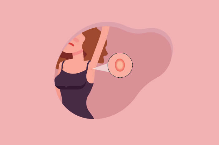 hidradenitis suppurativa, penyakit kulit hidradenitis suppurativa, penyakit kulit