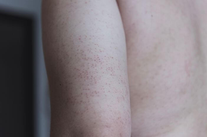 Idap Keratosis Pilaris, Tubuh Akan Alami Ini