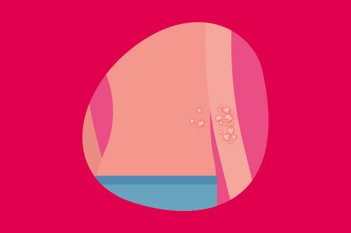 neurodermatitis, penyakit kulit yang tidak menular neurodermatitis, penyakit kulit yang tidak menular