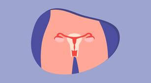 Ini 12 Tanda Kanker Ovarium yang Harus Diketahui Wanita