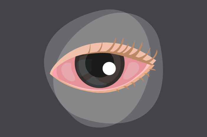 Ini Alasan Alkoholik Berisiko Tinggi Terkena Xerophthalmia Ini Alasan Alkoholik Berisiko Tinggi Terkena Xerophthalmia