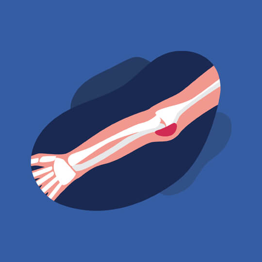 Inilah Tips Simpel Cegah Bursitis yang Bikin Sendi Terasa Sakit Inilah Tips Simpel Cegah Bursitis yang Bikin Sendi Terasa Sakit