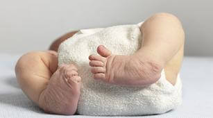 Kenali Cara Penanganan Clubfoot pada Bayi