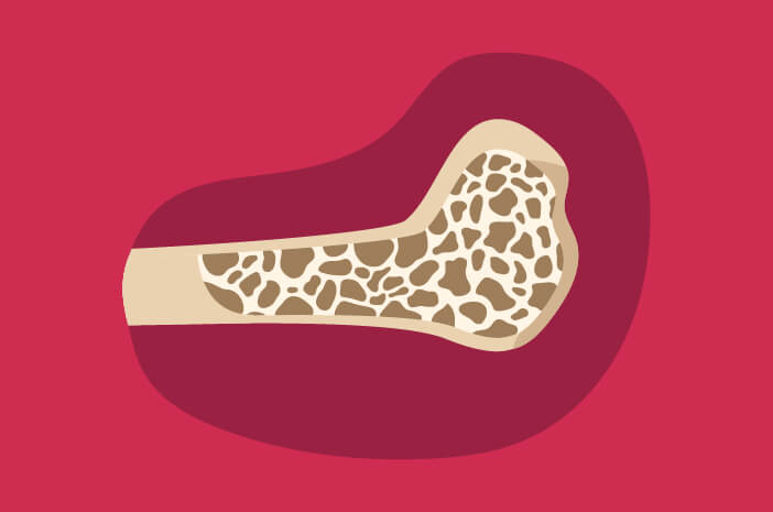 risiko osteoporosis risiko osteoporosis