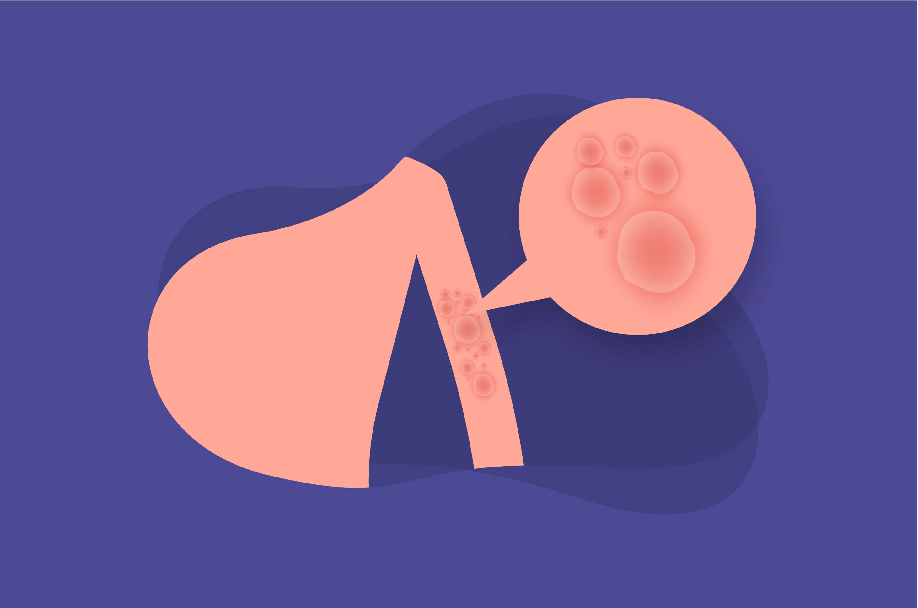 Ketahui 5 Pencegahan dari Kondisi Lichen Planus Ketahui 5 Pencegahan dari Kondisi Lichen Planus