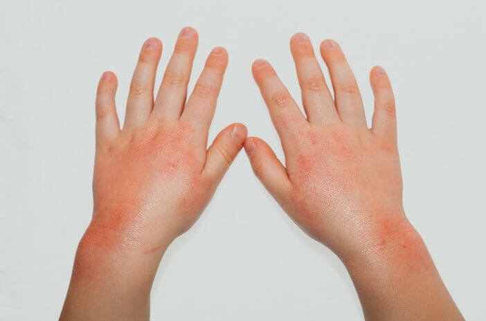 Ketahui Penyebab Munculnya Alergi pada Anak