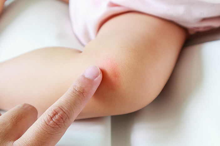 Kulit Bayi Lebih Rentan Dermatitis Atopik, Benarkah?