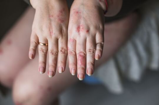 Lakukan Ini untuk Diagnosis Actinic Keratosis Lakukan Ini untuk Diagnosis Actinic Keratosis