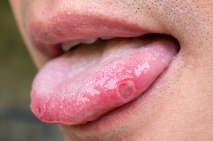 Lakukan Hal ini untuk Mencegah Stomatitis Lakukan Hal ini untuk Mencegah Stomatitis