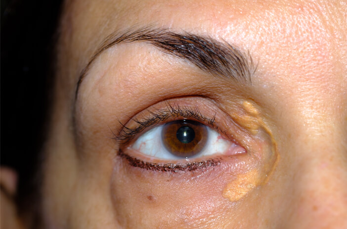 Makanan yang Baik untuk Pengidap Xanthelasma