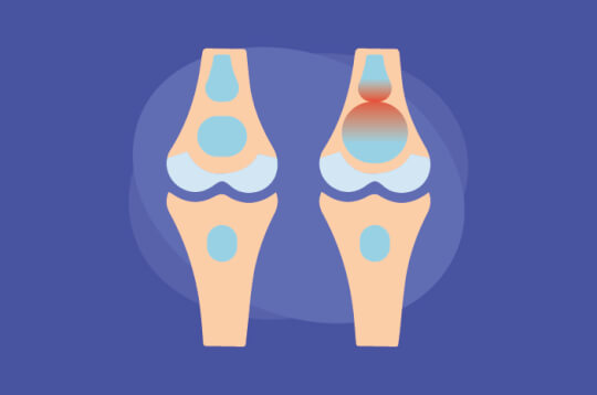 Mengalami 9 Gejala Ini? Awas, Bursitis Mengintai Mengalami 9 Gejala Ini? Awas, Bursitis Mengintai