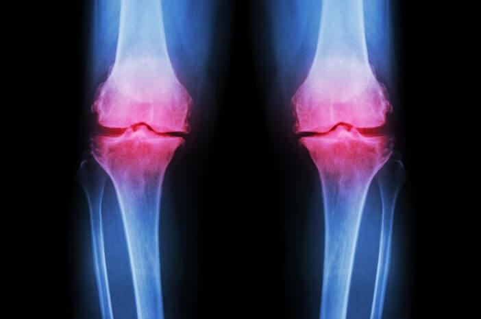 Mengapa Perempuan Lebih Berisiko Terkena Osteoartritis? Mengapa Perempuan Lebih Berisiko Terkena Osteoartritis?