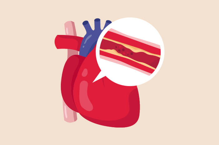 Mengidap Dislipidemia, Inilah Pilihan Pengobatannya Mengidap Dislipidemia, Inilah Pilihan Pengobatannya