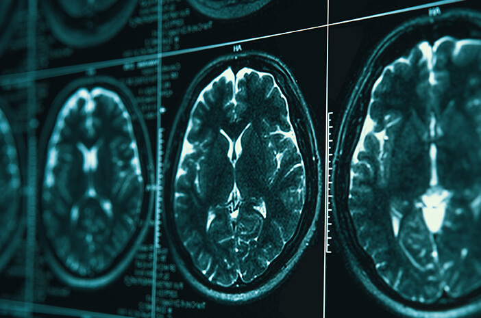 Mengidap Encephalomalacia, Bisakah Disembuhkan? Mengidap Encephalomalacia, Bisakah Disembuhkan?
