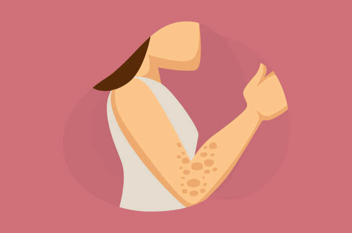 hidradenitis suppurativa, depresi, peradangan kulit hidradenitis suppurativa, depresi, peradangan kulit
