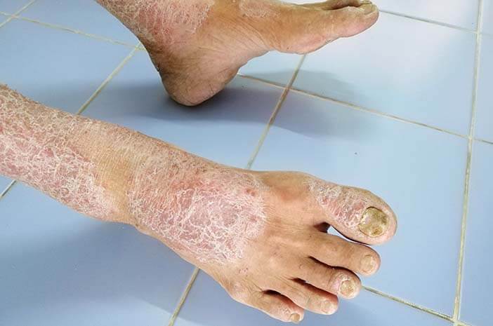 Mengidap Skleroderma, Ikuti Gaya Hidup Sehat Ini
