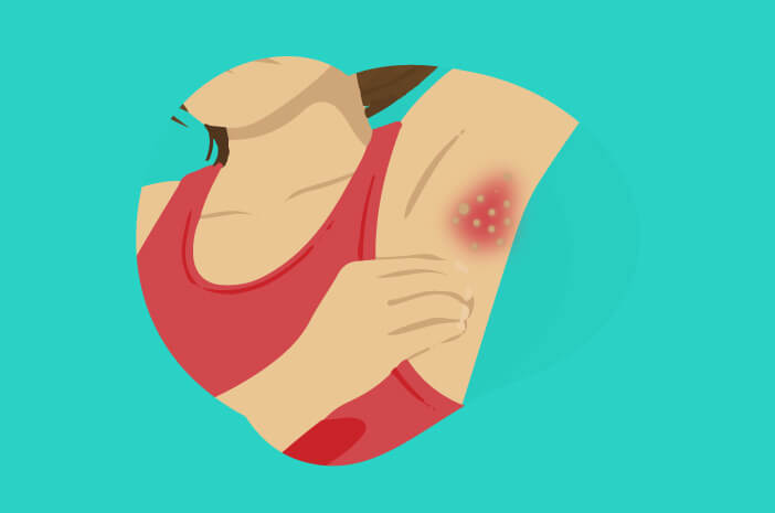 Menyerang Kulit, Inilah 4 Gejala Hidradenitis Suppurativa Menyerang Kulit, Inilah 4 Gejala Hidradenitis Suppurativa