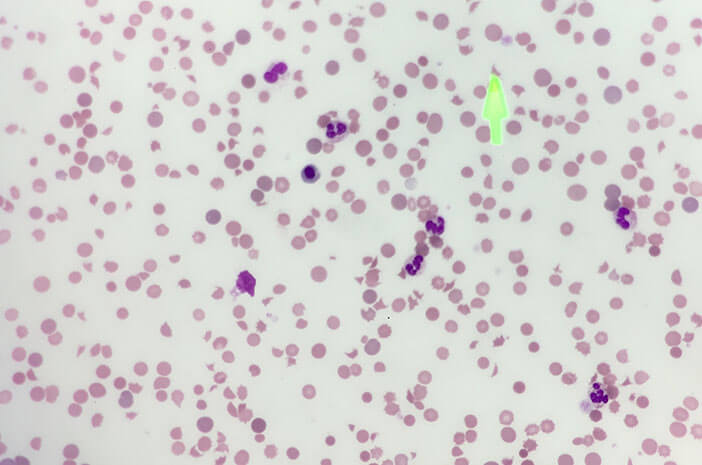 Mutasi Genetik Bisa Sebabkan Paroxysmal Nocturnal Hemoglobinuria