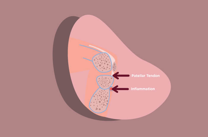 Osgood-Schlatter Disease, Salah Satu Penyakit Unik yang Perlu Diketahui