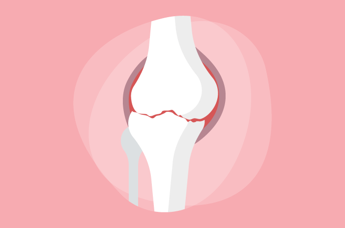 Osteoarthritis Sebabkan Kista Baker, Ini Alasannya Osteoarthritis Sebabkan Kista Baker, Ini Alasannya