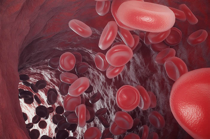Inilah yang Perlu Diketahui tentang Anemia Hemolitik
