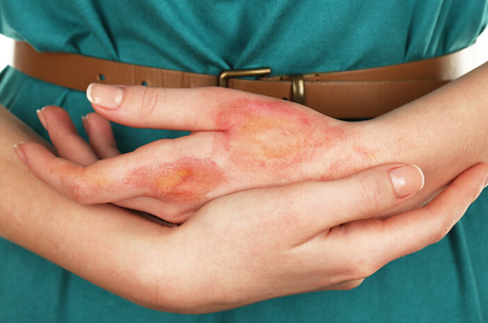 perlu-diwaspadai-ini-penyebab-nekrolisis-epidermal-toksik-halodoc perlu-diwaspadai-ini-penyebab-nekrolisis-epidermal-toksik-halodoc