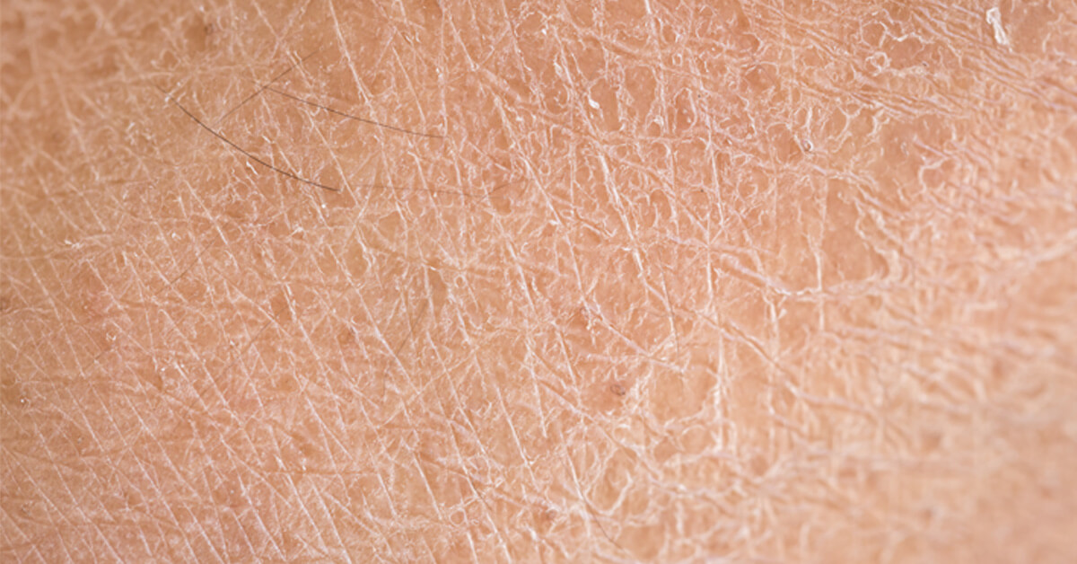 Selain Kulit, Lichen Planus Bisa Serang 4 Anggota Tubuh Ini