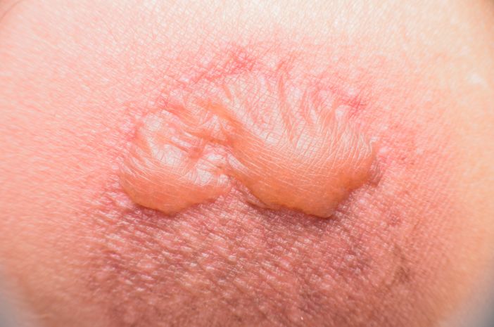 Selain Kulit, Nekrolisis Epidermal Toksik Serang Bagian Ini Selain Kulit, Nekrolisis Epidermal Toksik Serang Bagian Ini