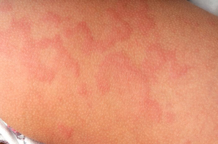 Waspadai Komplikasi yang Disebabkan Basal Cell Carcinoma Waspadai Komplikasi yang Disebabkan Basal Cell Carcinoma