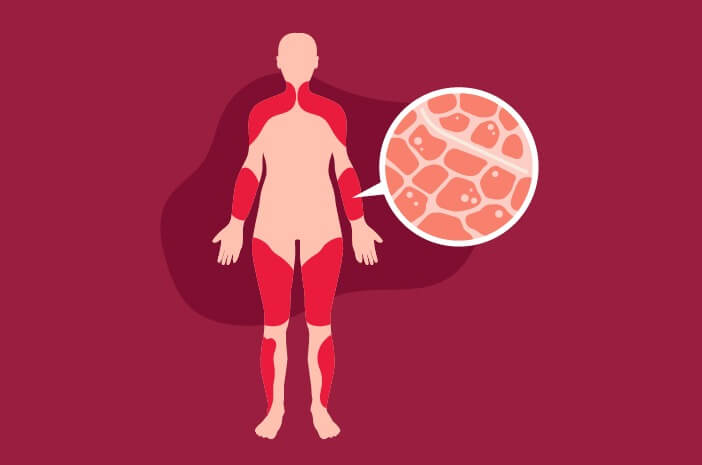 Kondisi myositis halodoc Kondisi myositis halodoc