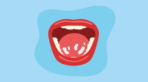 Leukoplakia, kerusakan jaringan mulut, kanker mulut
