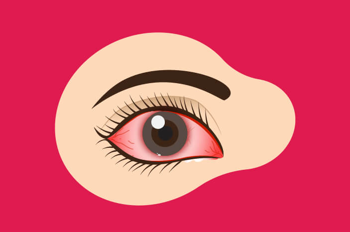 Xerophthalmia Bisa Sebabkan Kebutaan, Ini Alasannya Xerophthalmia Bisa Sebabkan Kebutaan, Ini Alasannya
